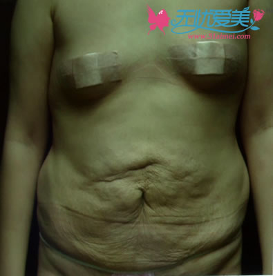 韩国seroi整形医院腹部整形让辣妈重燃自信
