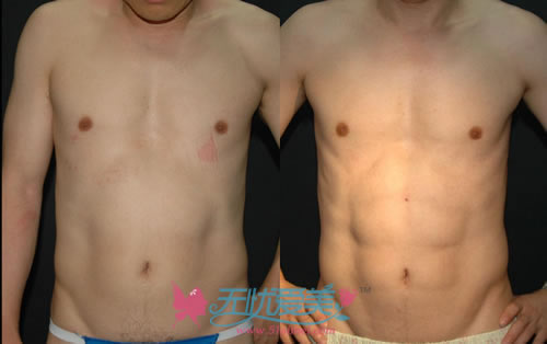 韩国Seroi整形医院吸脂吸出腹肌对比案例图
