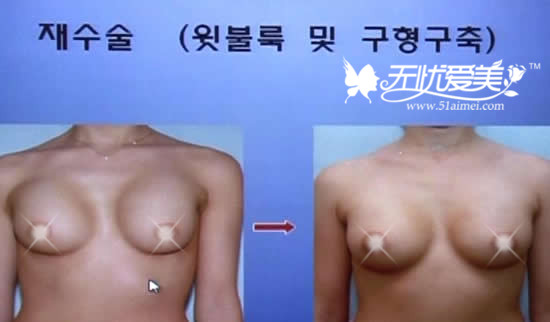 韩国MD整形医院胸部有硬结修复对比案例
