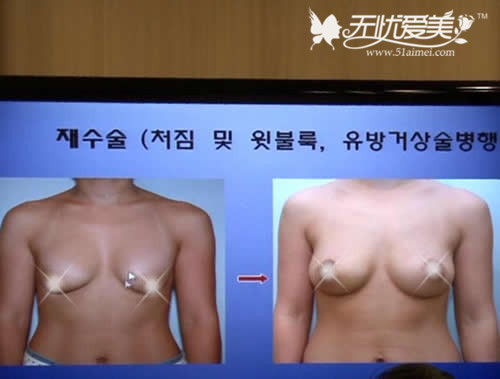 韩国MD整形医院隆胸手术案例