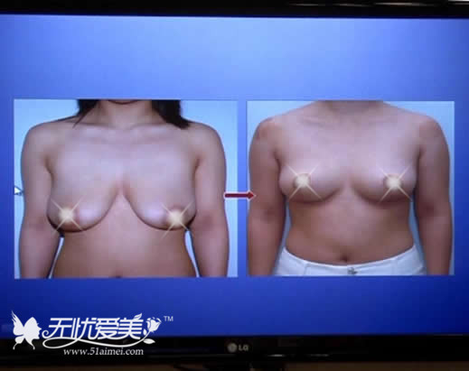 韩国MD整形医院乳房下垂矫正手术案例