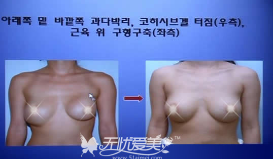 韩国MD整形医院胸部不对称、有硬结修复对比案例