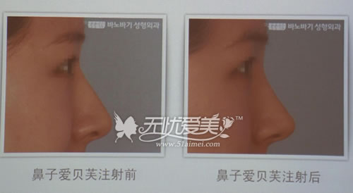 韩国巴诺巴奇整形医院爱贝芙注射隆鼻前后对比案例