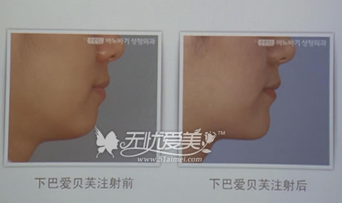 韩国巴诺巴奇整形医院爱贝芙注射下巴前后对比案例