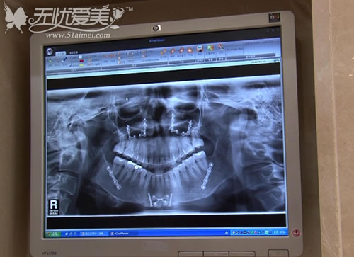 韩国IAM口腔医院骨骼CT处